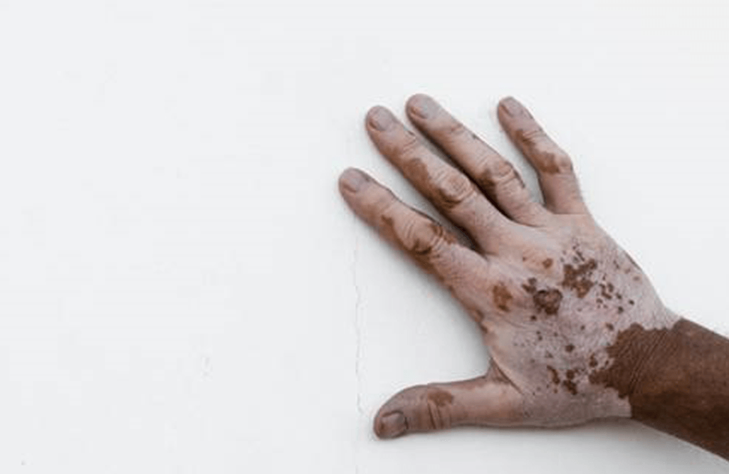 Vitiligo