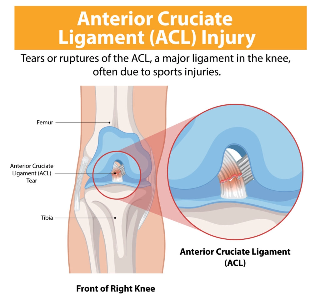 Anterior CruciateLigament Injury